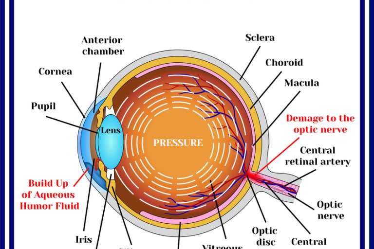 Normal vision. Glaucoma.