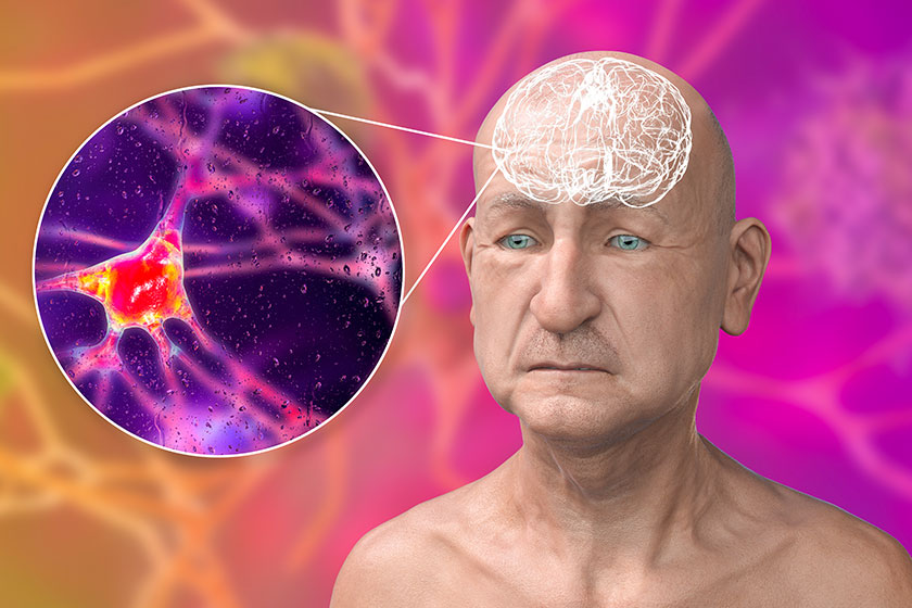 dementia conceptual illustration showing elderly person progressive impairments brain functions