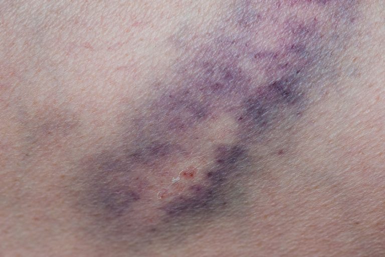 bruise injury young woman knee close view