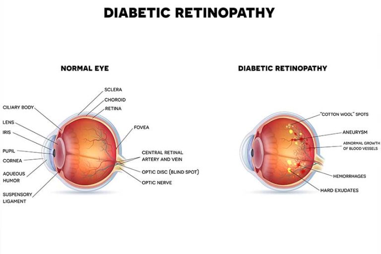 diabetic retinopathy and healthy eye